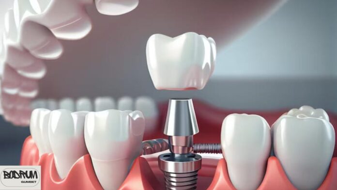 Dental Implants Turkey